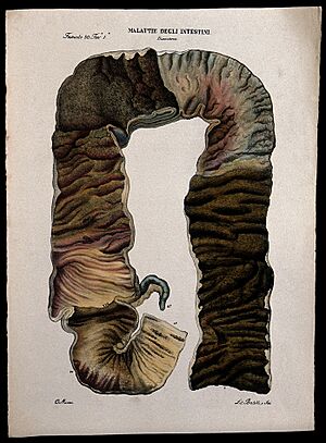 Archivo:A cross-section of diseased intestines (dysentery). Coloured Wellcome V0009858ER