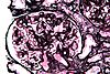 Membranous nephropathy - alt - mpas - very high mag.jpg
