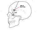 Lobotomy 1